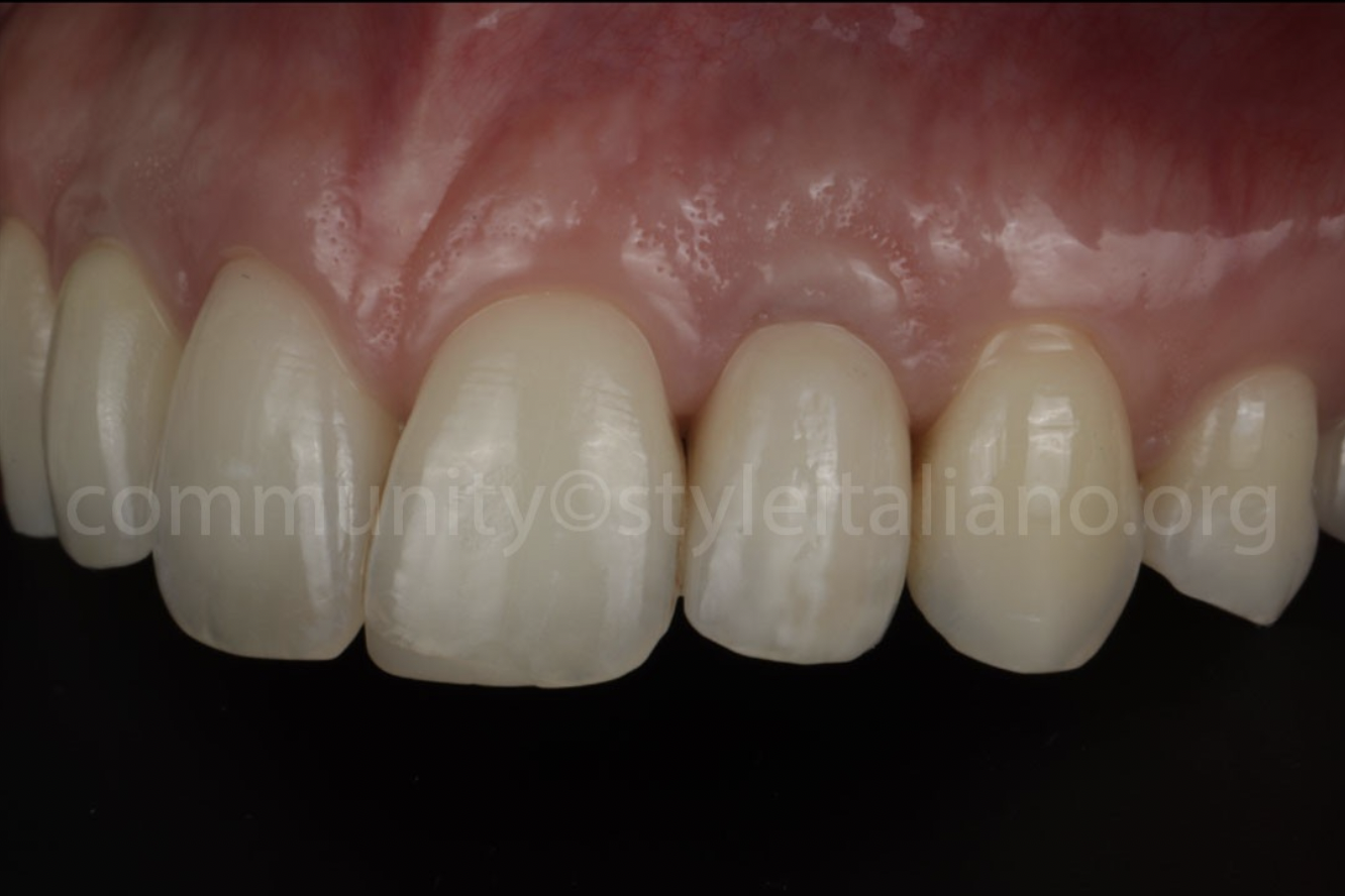 Điều Trị Lại Một Mão Răng Trên Implant: Tối ưu hoá kết quả bằng phần mềm OptiShade